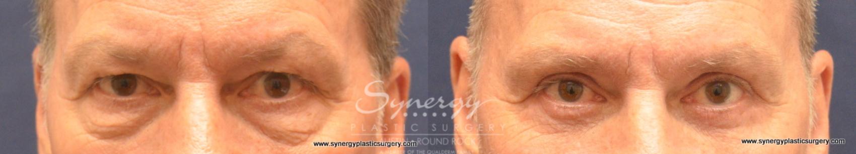 Before & After Eyelid Surgery (Blepharoplasty) Case 724 View #1 View in Round Rock, TX