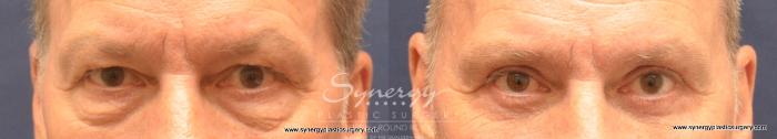 Before & After Eyelid Surgery (Blepharoplasty) Case 724 View #1 View in Austin, TX
