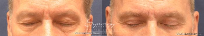 Before & After Eyelid Surgery (Blepharoplasty) Case 724 View #2 View in Austin, TX