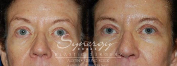 Before & After Eyelid Surgery (Blepharoplasty) Case 75 View #1 View in Austin, TX