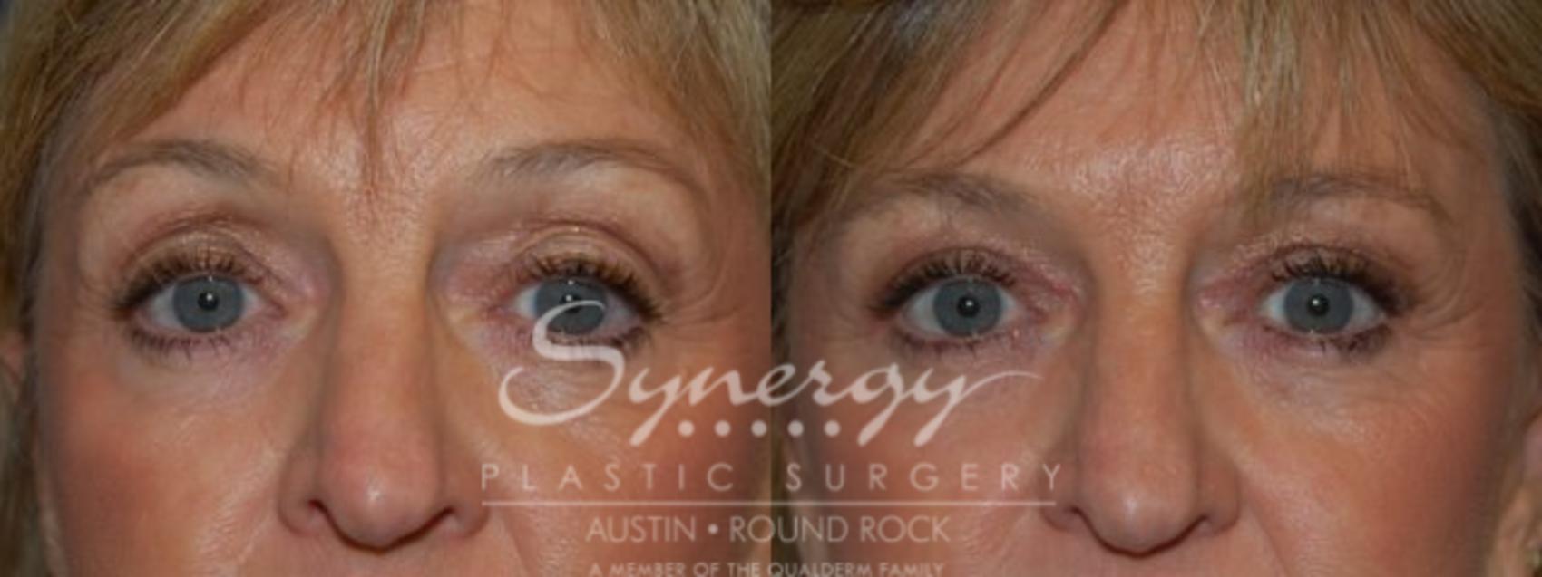 Before & After Eyelid Surgery (Blepharoplasty) Case 79 View #1 View in Round Rock, TX