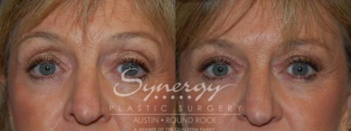 Before & After Eyelid Surgery (Blepharoplasty) Case 79 View #1 View in Austin, TX