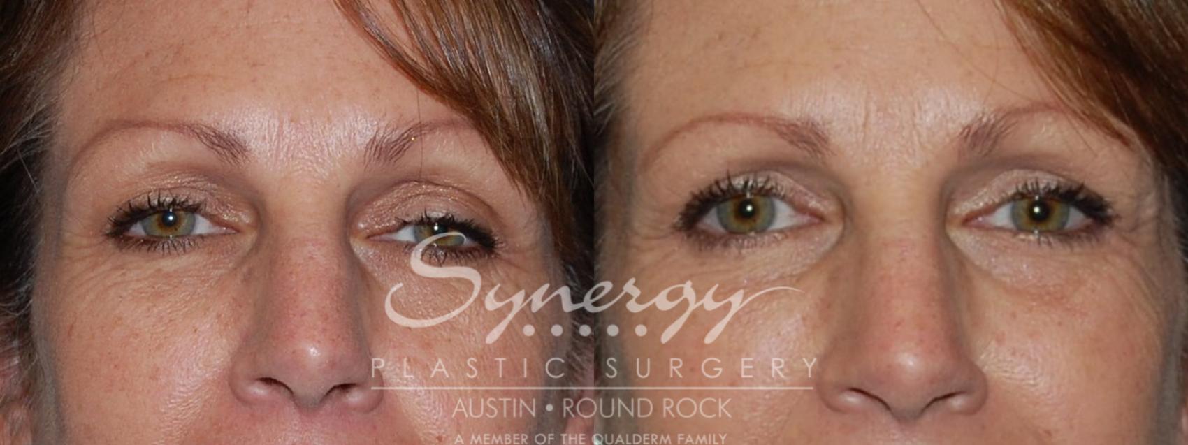 Before & After Eyelid Surgery (Blepharoplasty) Case 87 View #1 View in Round Rock, TX