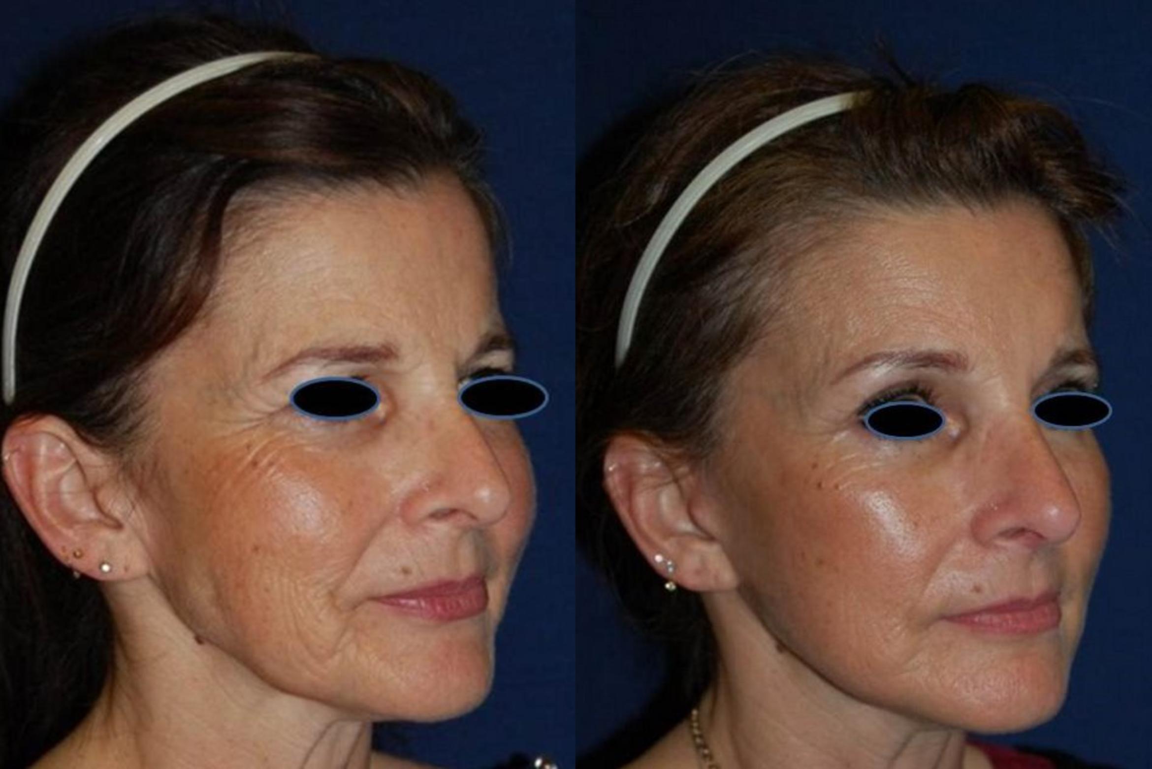 Before & After Facelift Case 123 View #1 View in Round Rock, TX