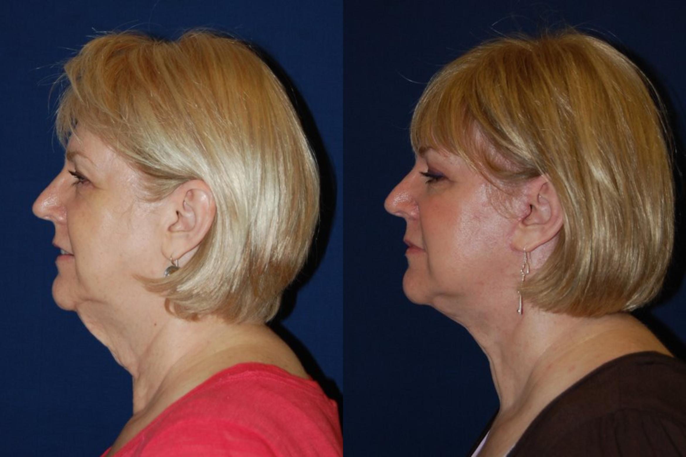 Before & After Facelift Case 128 View #1 View in Round Rock, TX