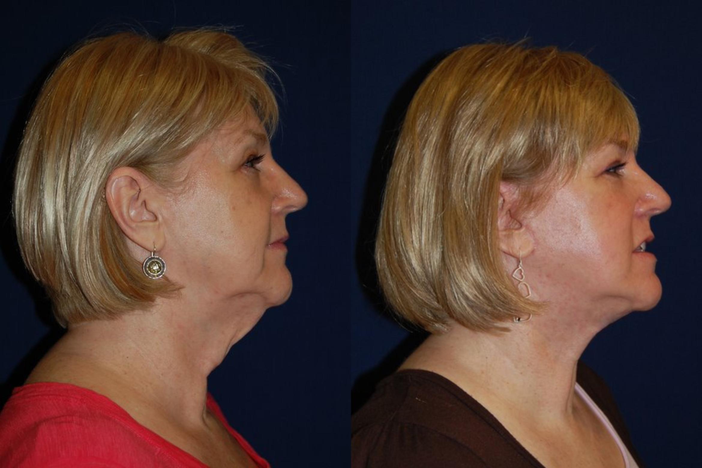 Before & After Facelift Case 128 View #2 View in Round Rock, TX