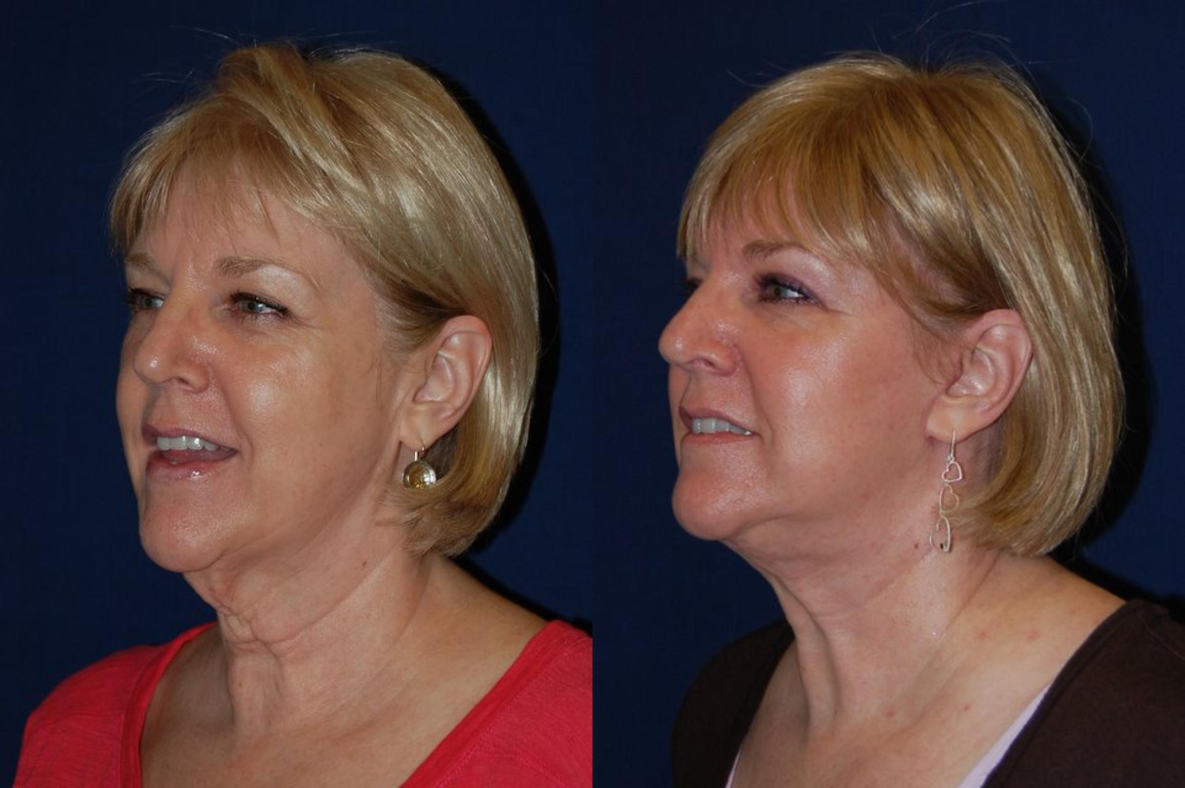 Before & After Facelift Case 128 View #3 View in Round Rock, TX
