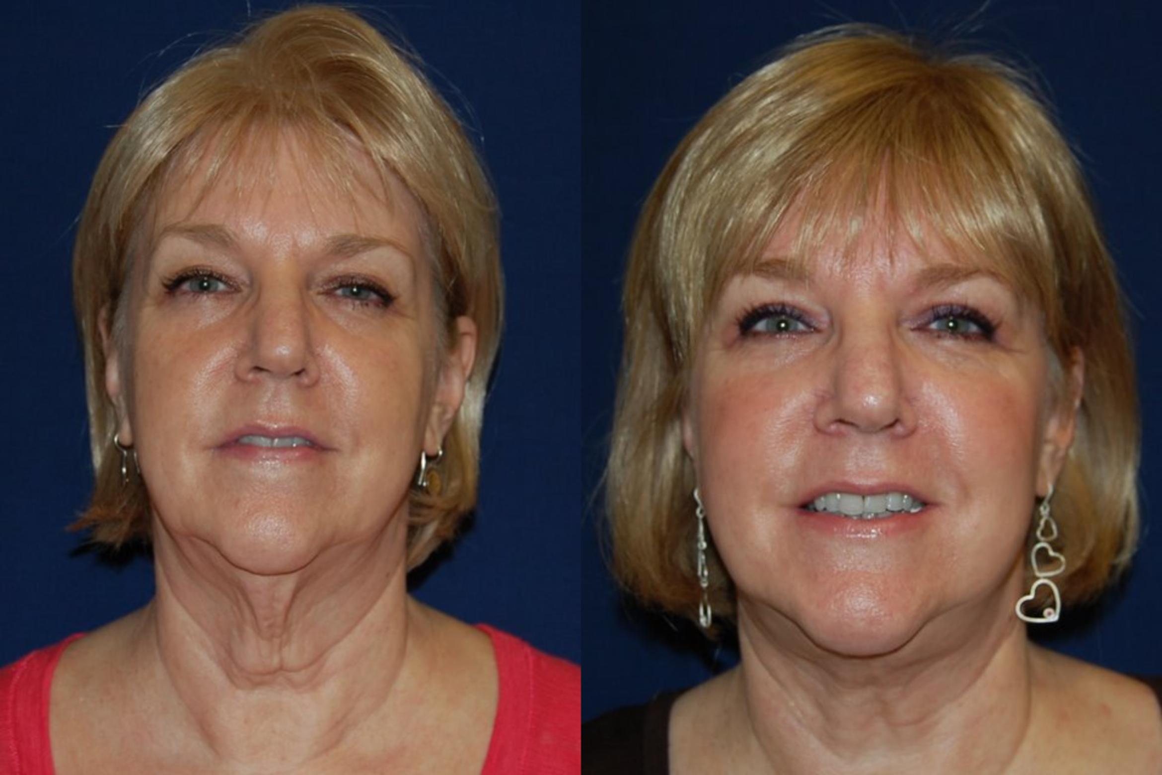 Before & After Facelift Case 128 View #4 View in Round Rock, TX