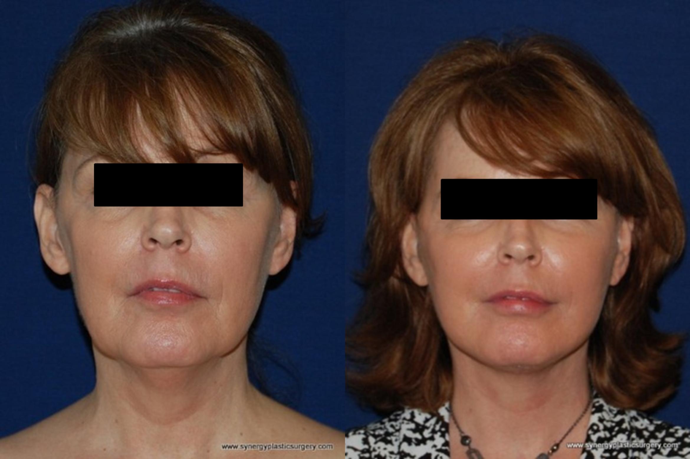 Before & After Facelift Case 177 View #2 View in Round Rock, TX