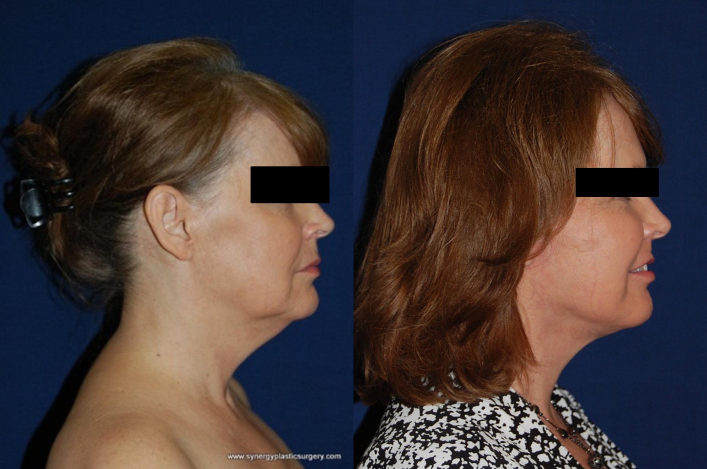 Before & After Facelift Case 177 View #3 View in Round Rock, TX