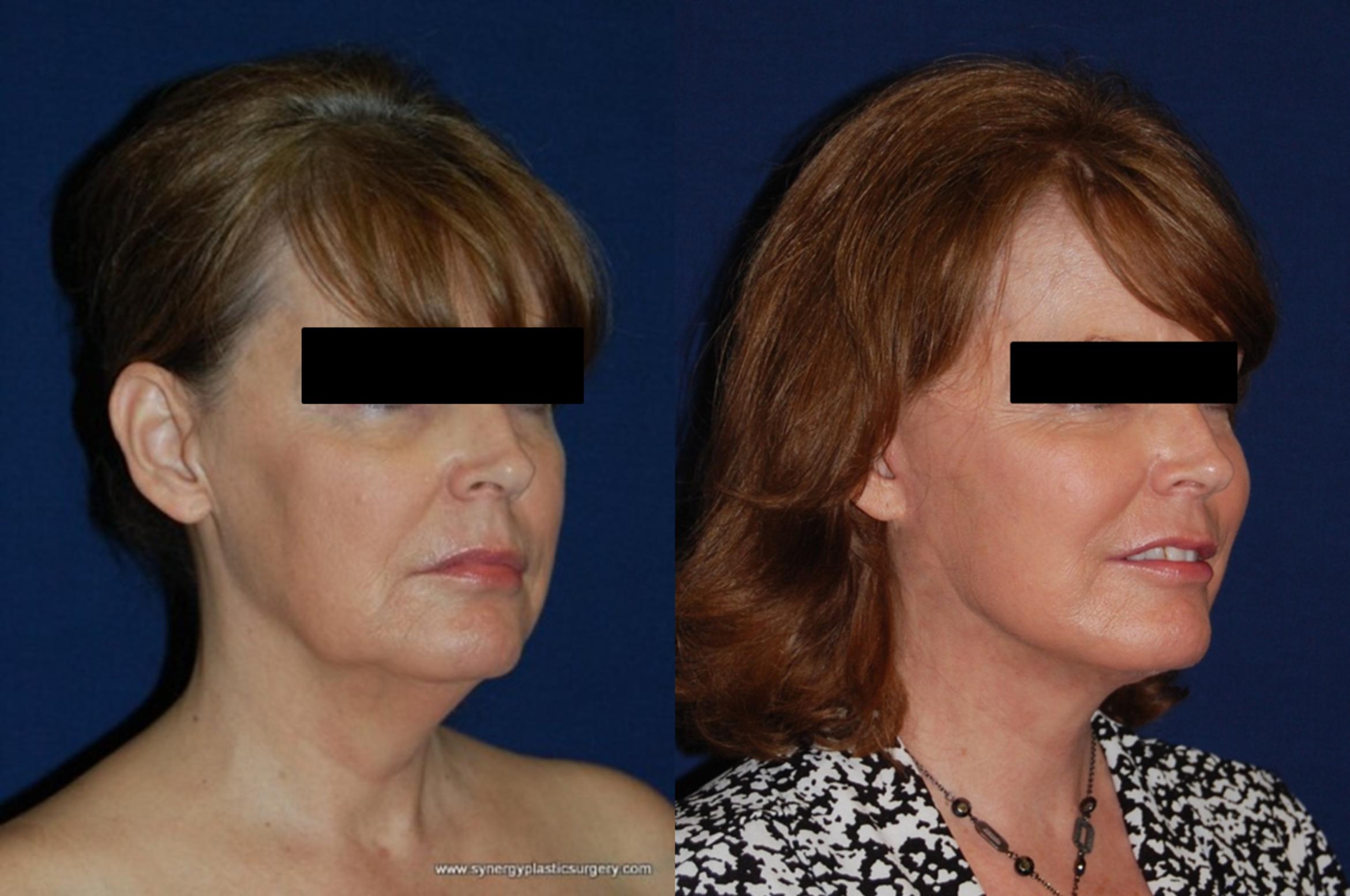 Before & After Facelift Case 177 View #4 View in Round Rock, TX