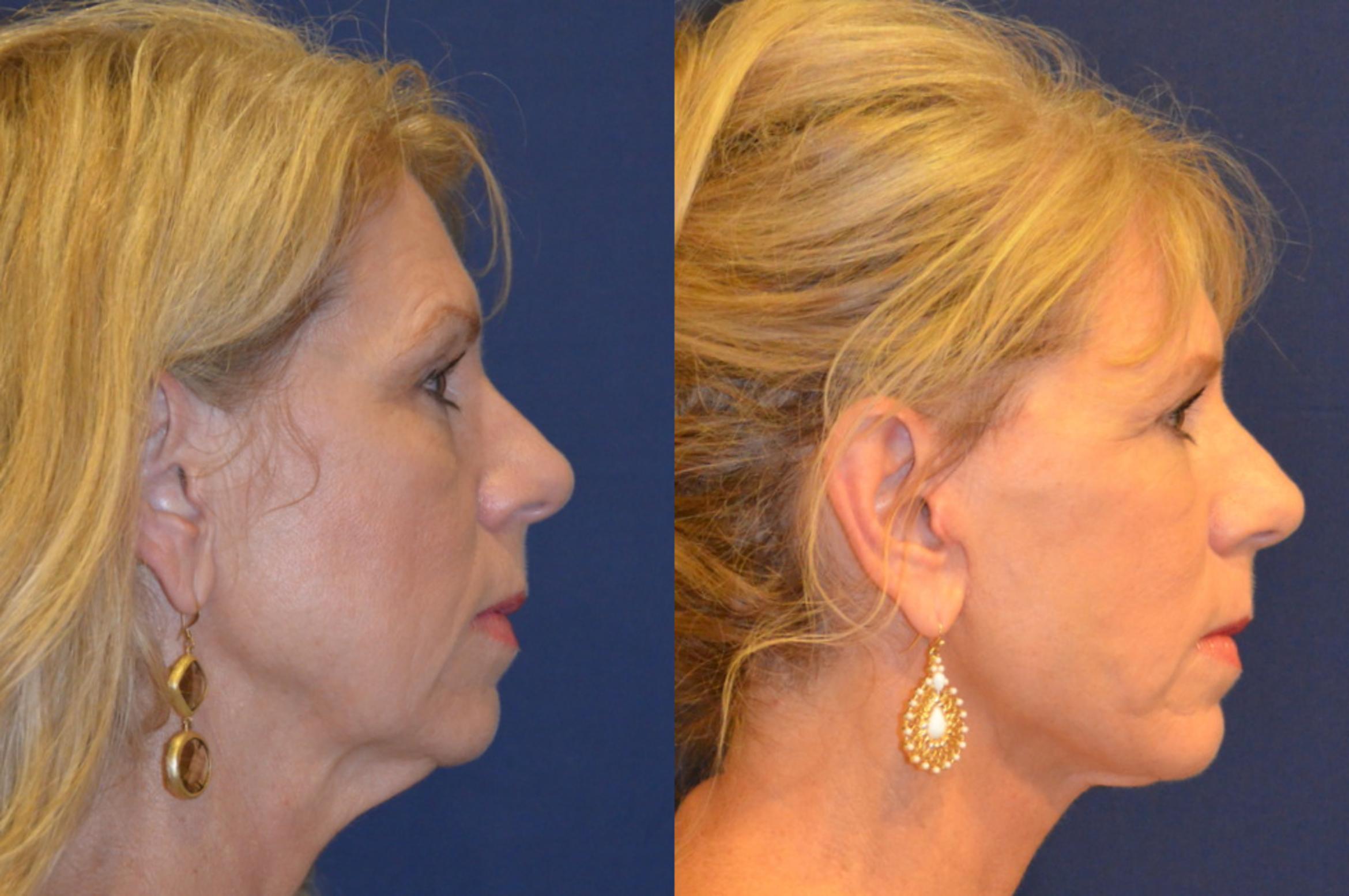 Before & After Facelift Case 296 View #2 View in Round Rock, TX