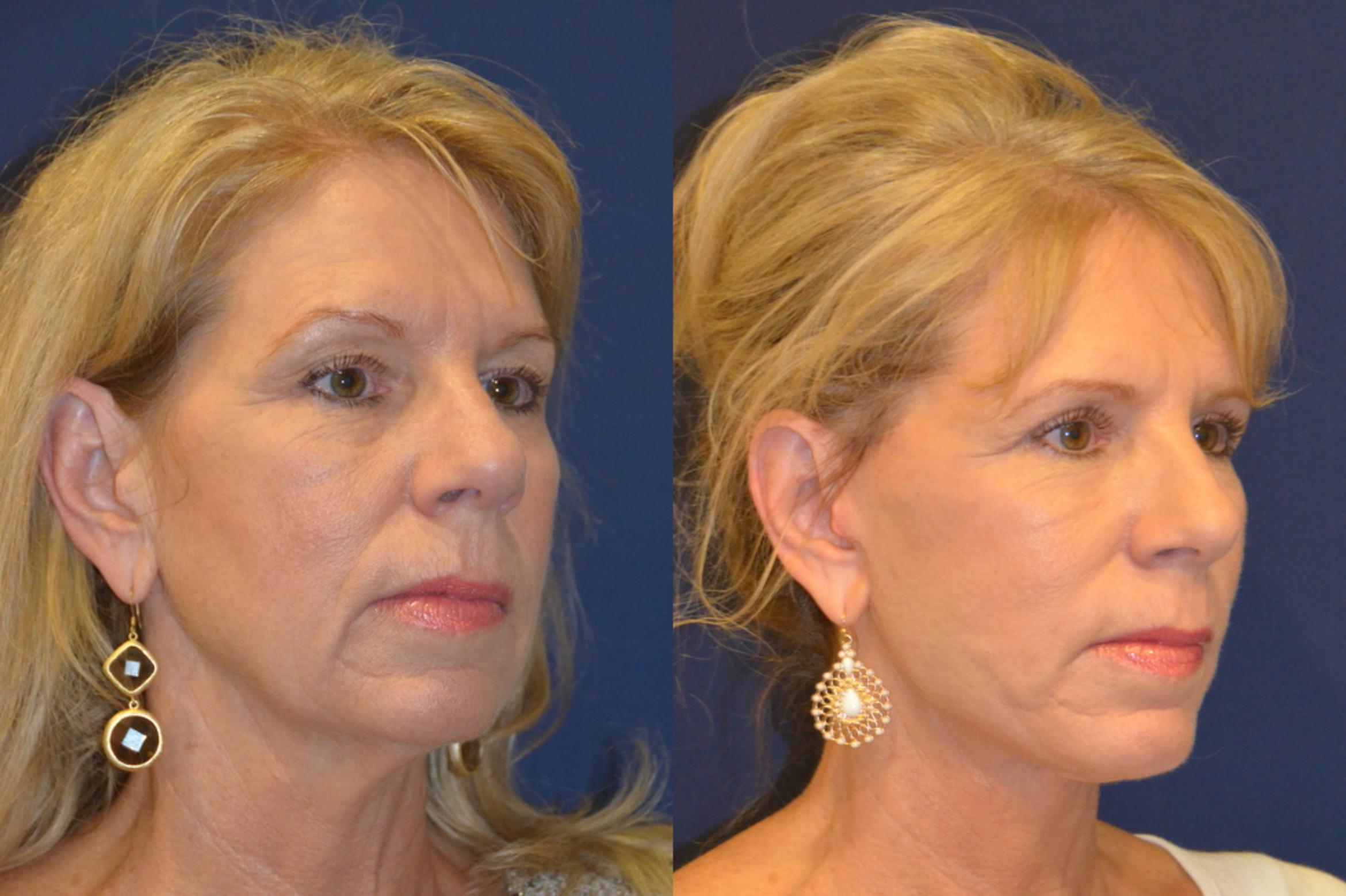 Before & After Facelift Case 296 View #3 View in Round Rock, TX