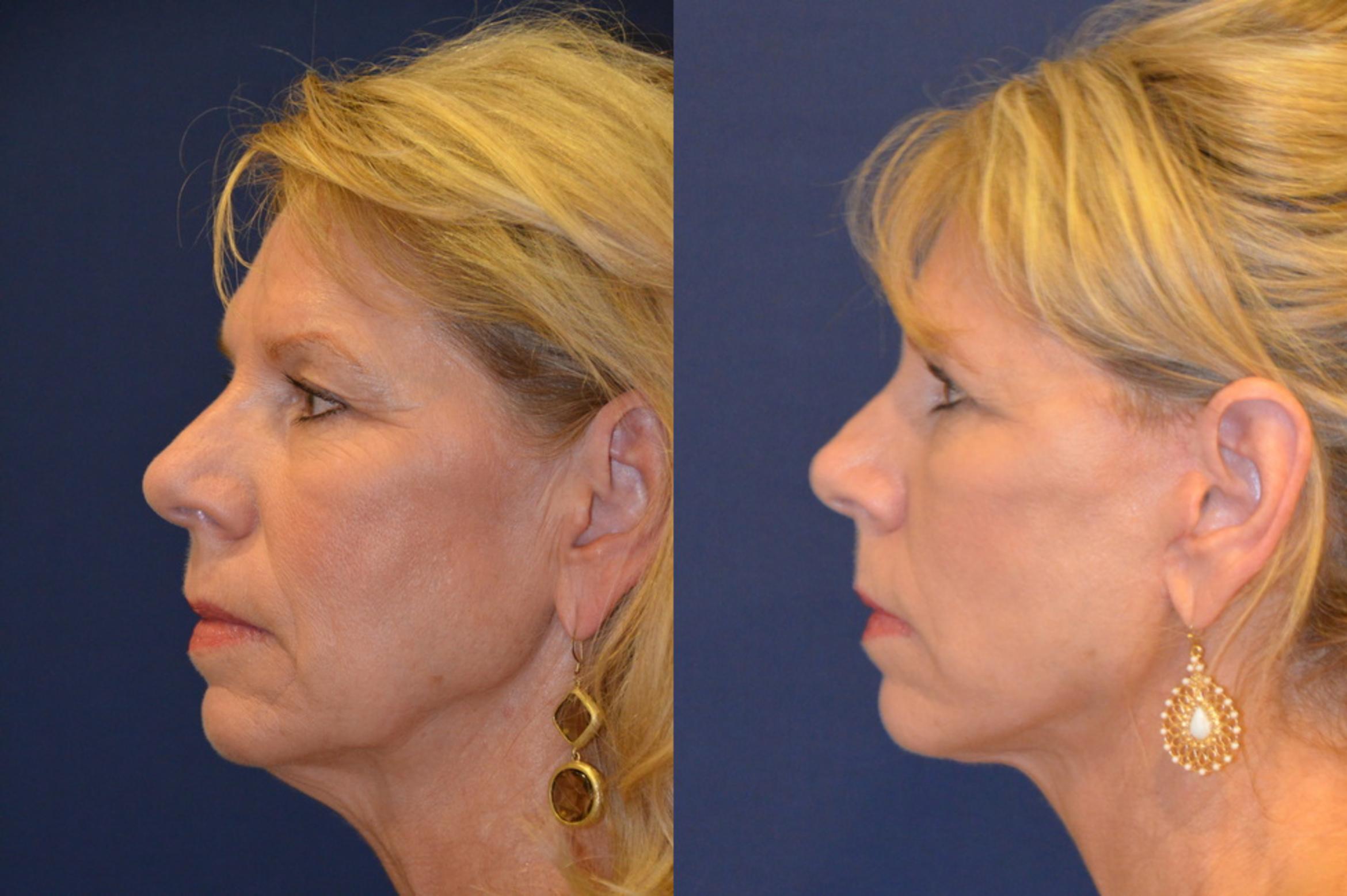 Before & After Facelift Case 296 View #4 View in Round Rock, TX