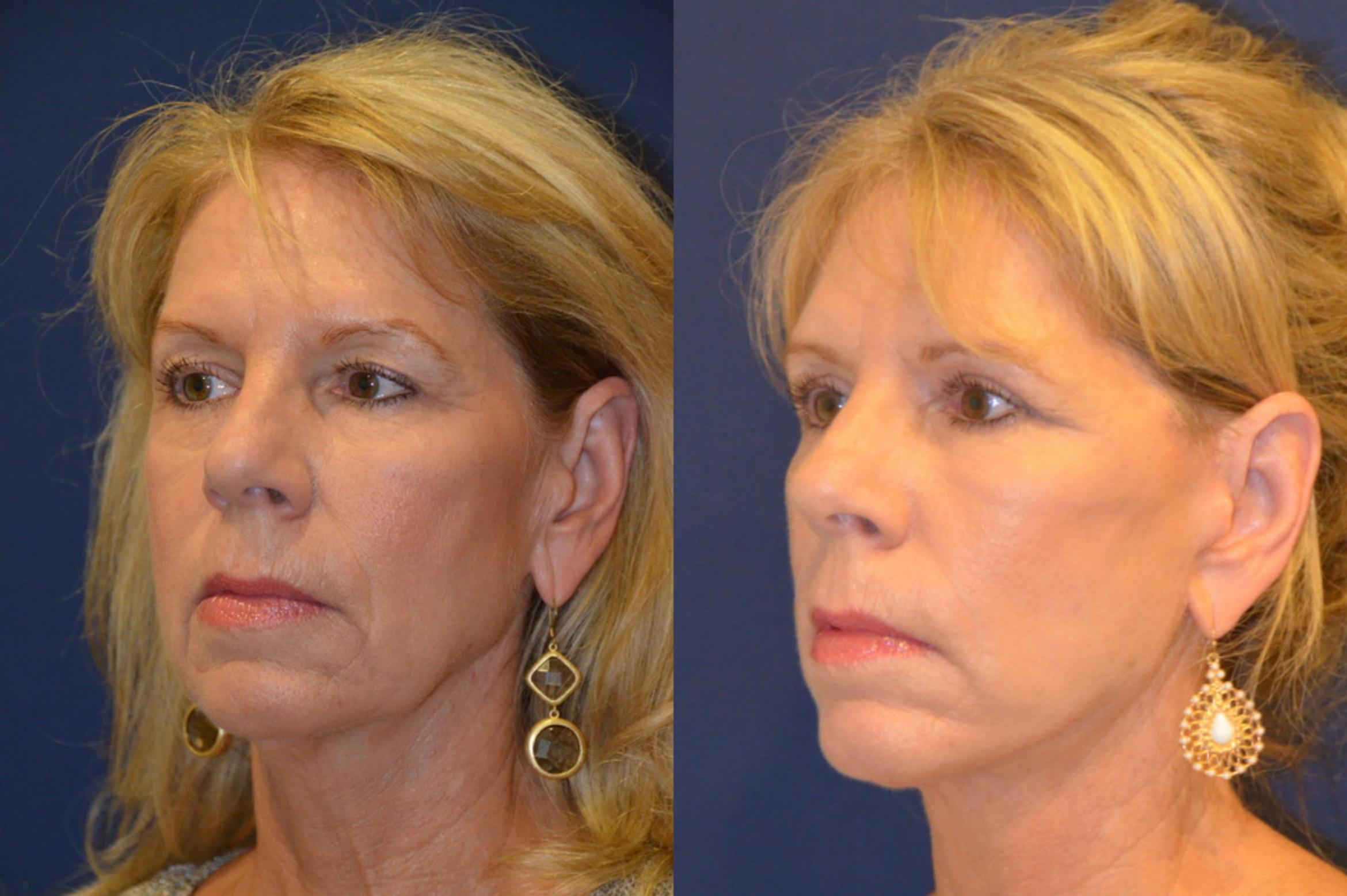 Before & After Facelift Case 296 View #5 View in Round Rock, TX