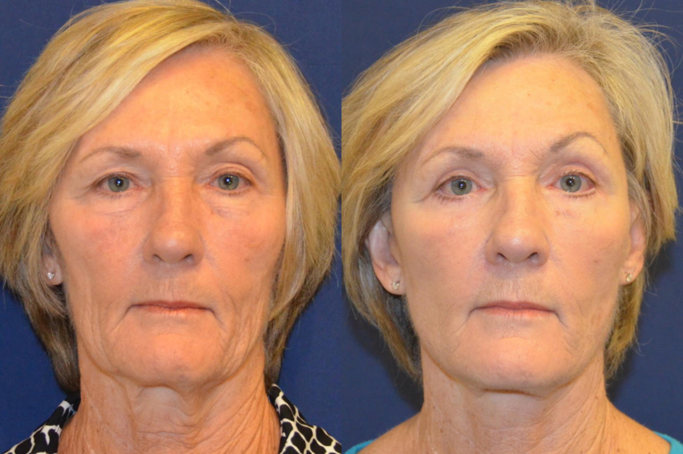Before & After Facelift Case 367 View #1 View in Round Rock, TX