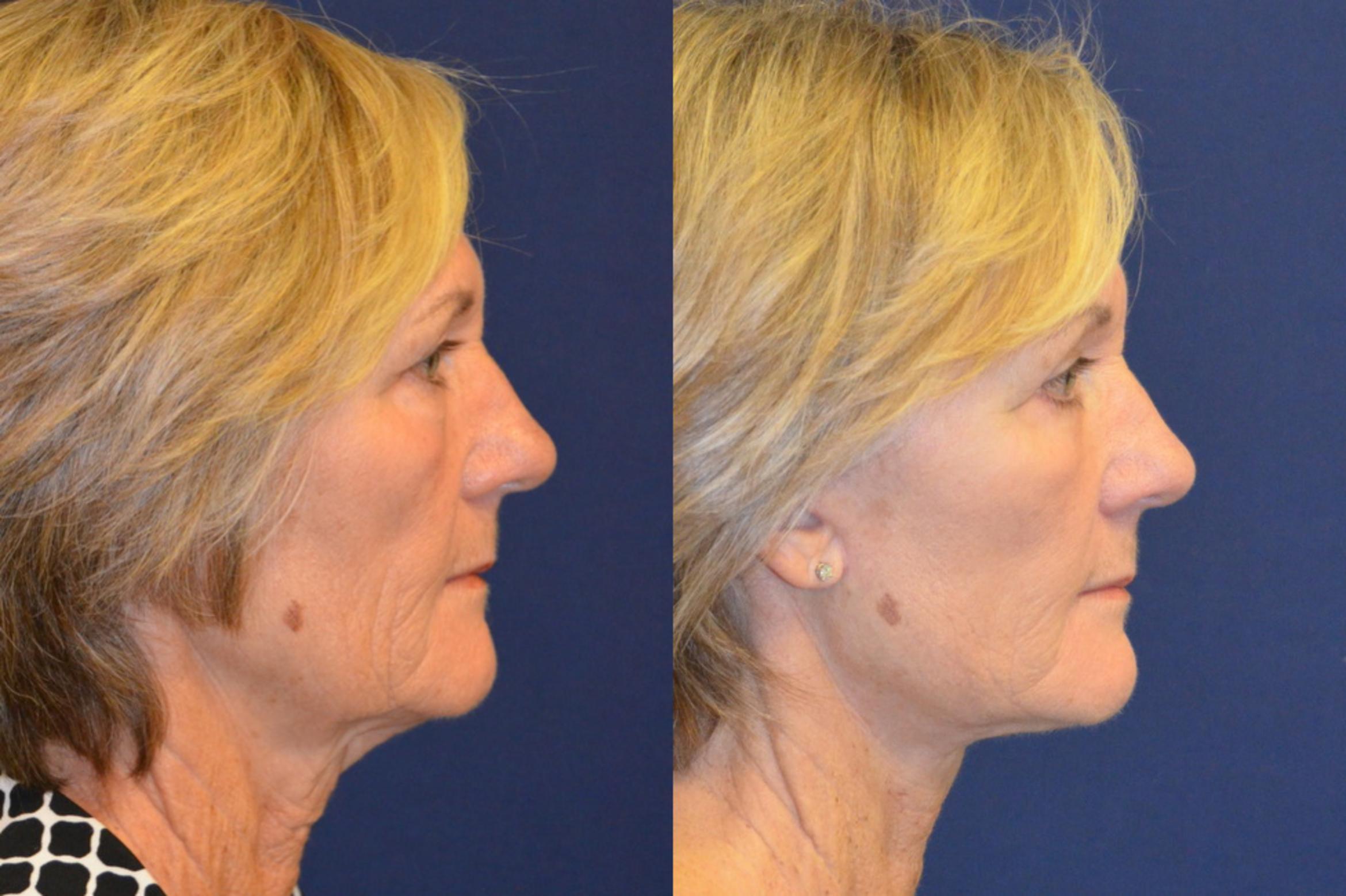 Before & After Facelift Case 367 View #2 View in Round Rock, TX