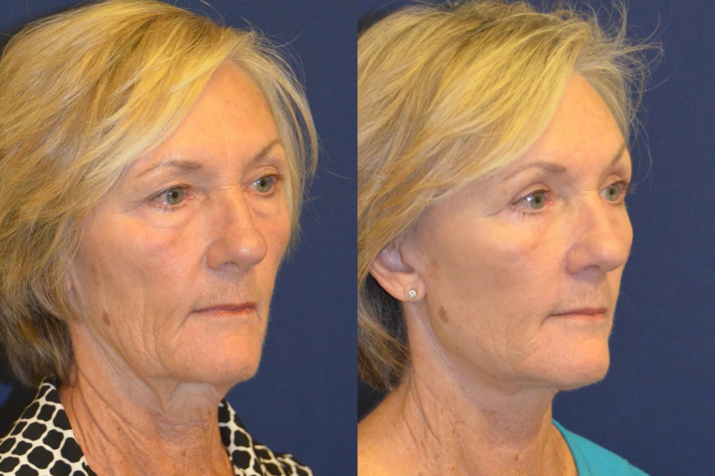 Before & After Facelift Case 367 View #3 View in Round Rock, TX