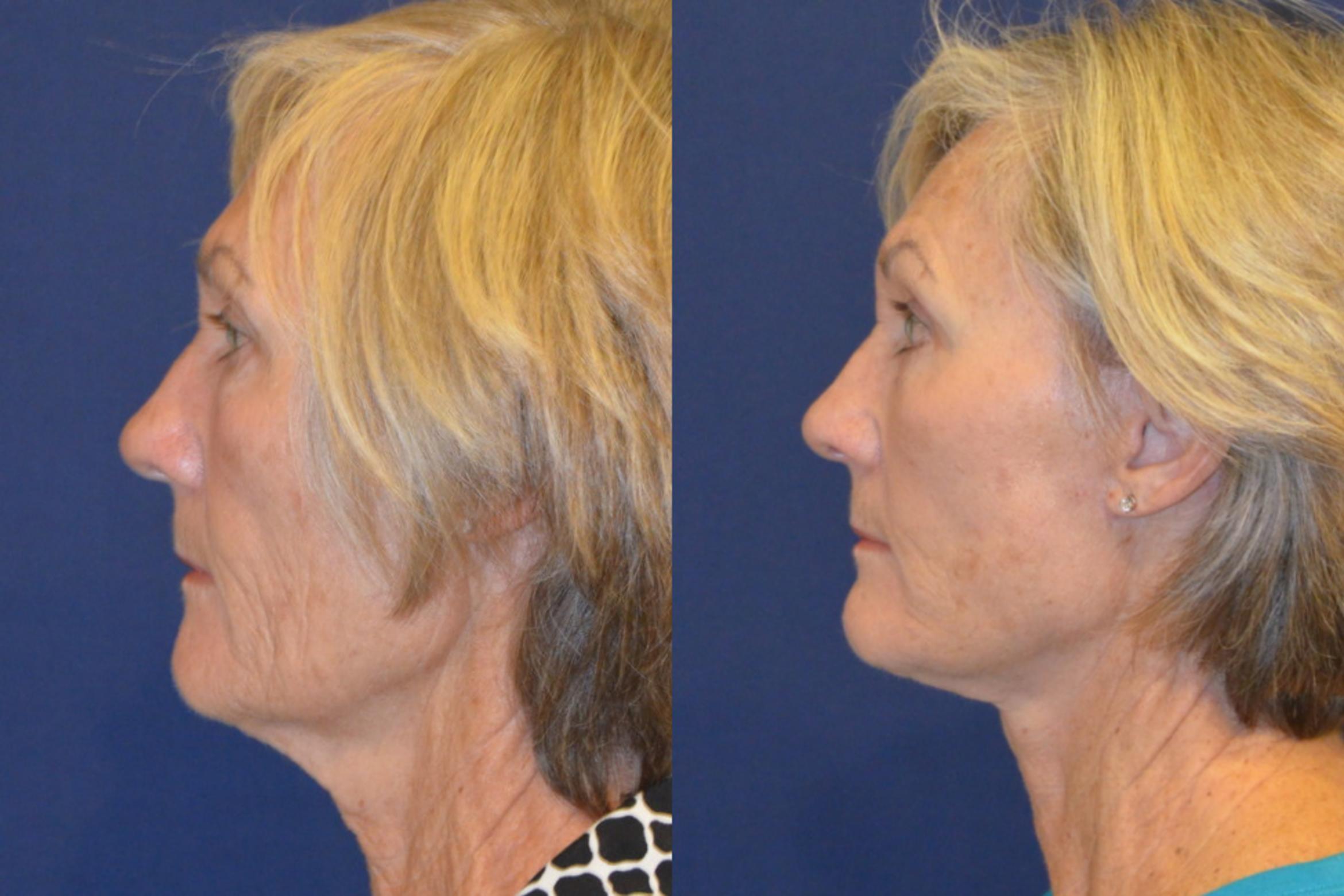 Before & After Facelift Case 367 View #4 View in Round Rock, TX