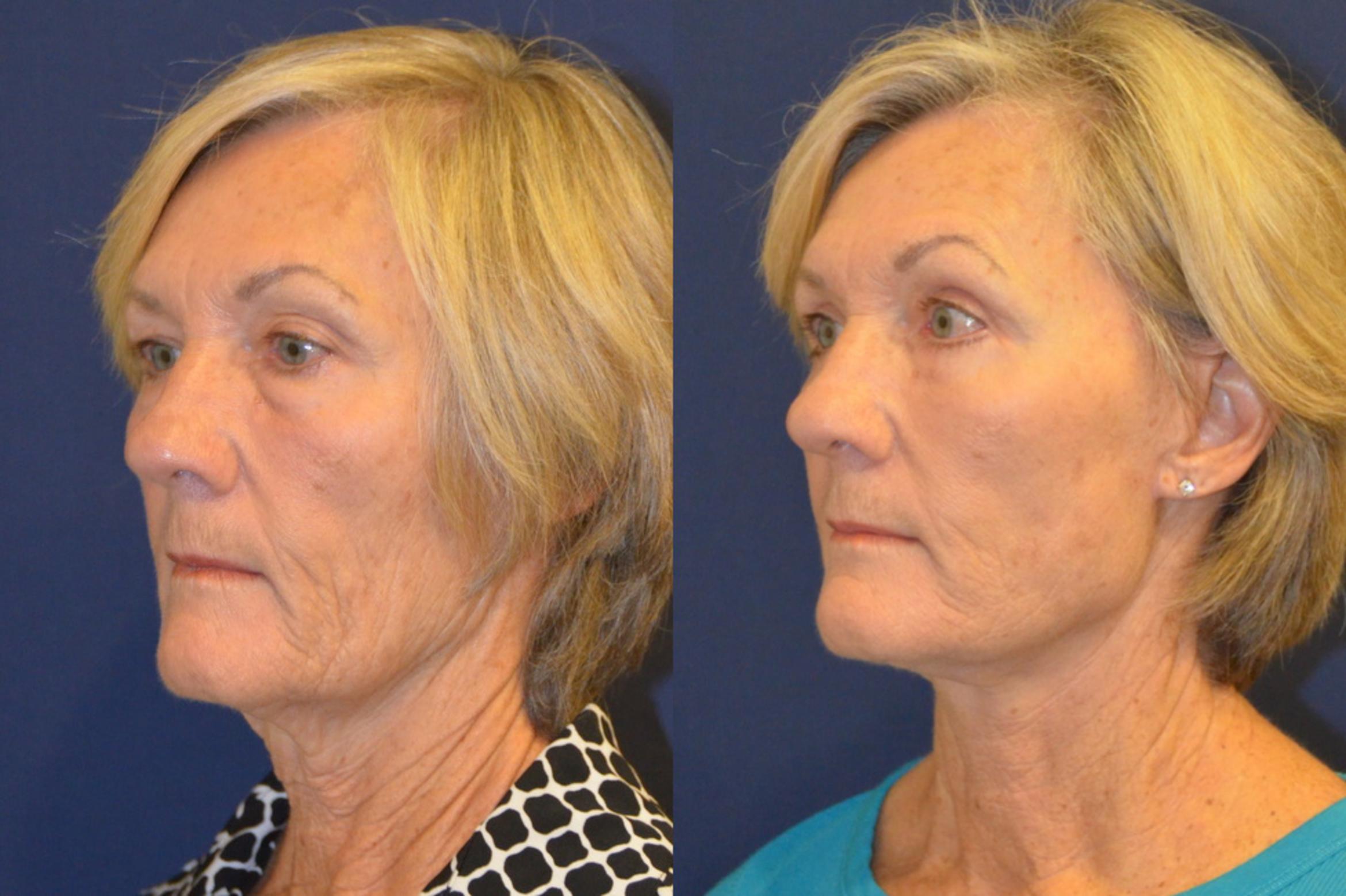 Before & After Facelift Case 367 View #5 View in Round Rock, TX