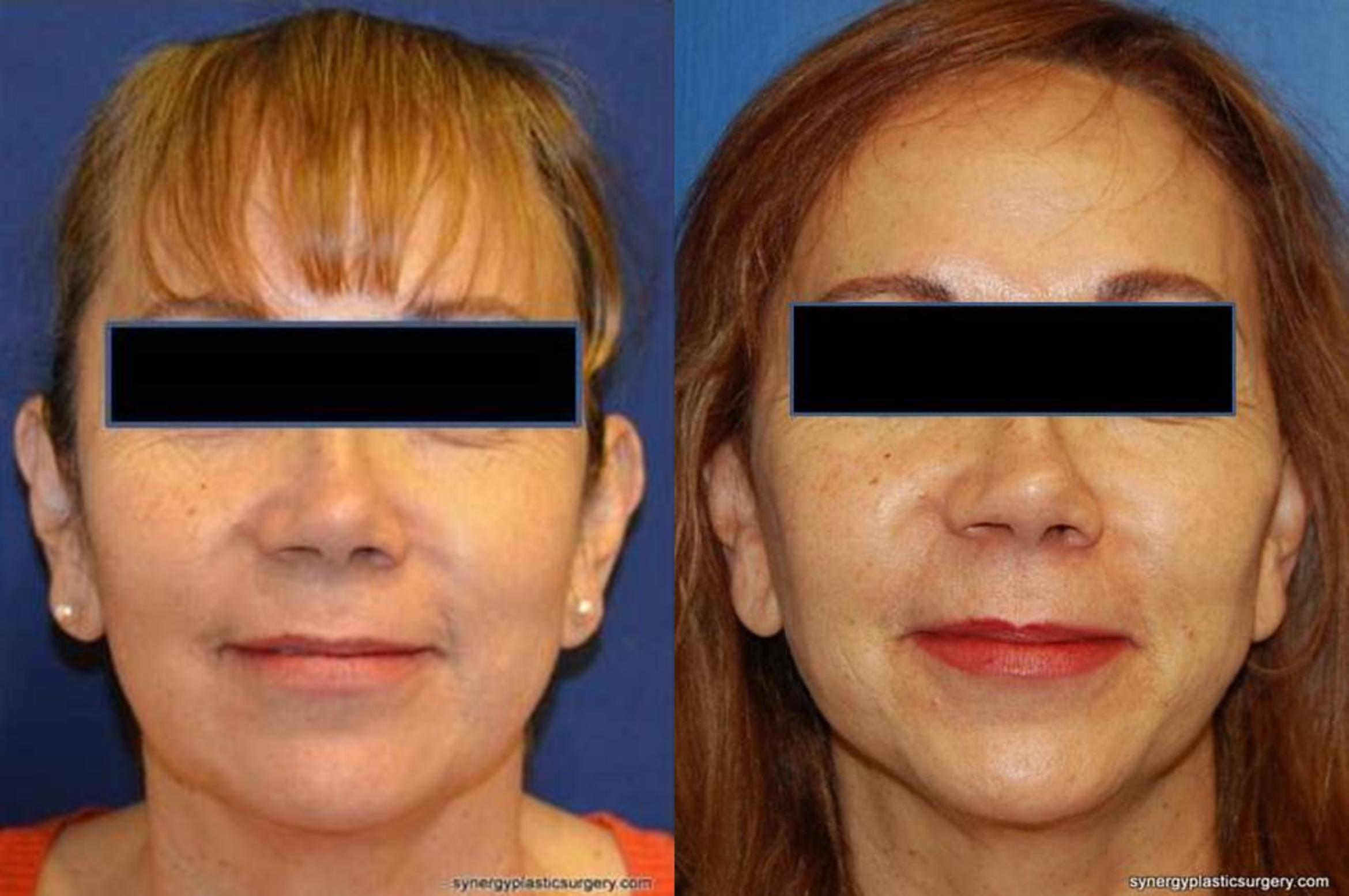 Before & After Facelift Case 371 View #1 View in Round Rock, TX
