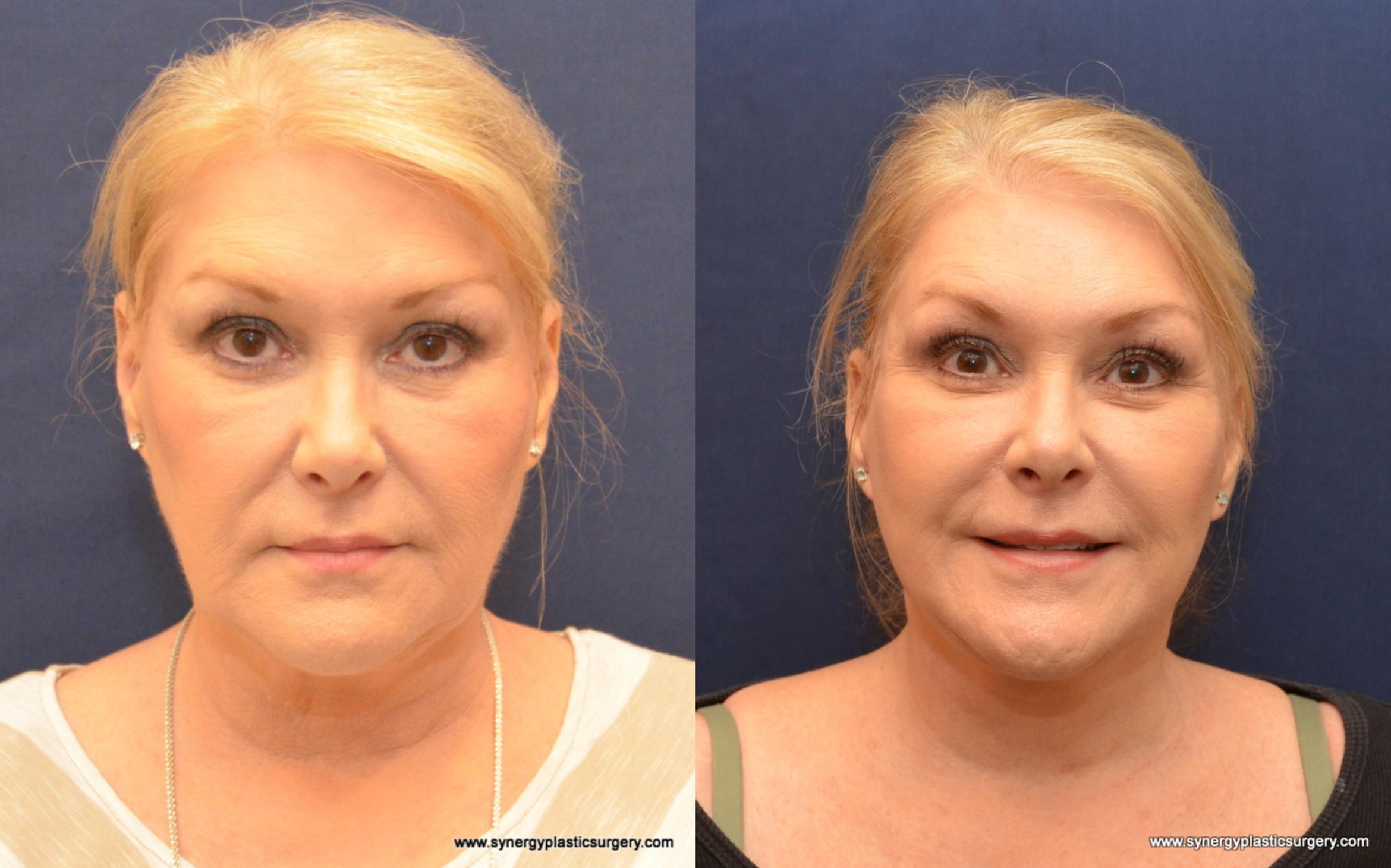 Before & After Facelift Case 526 View #1 View in Round Rock, TX