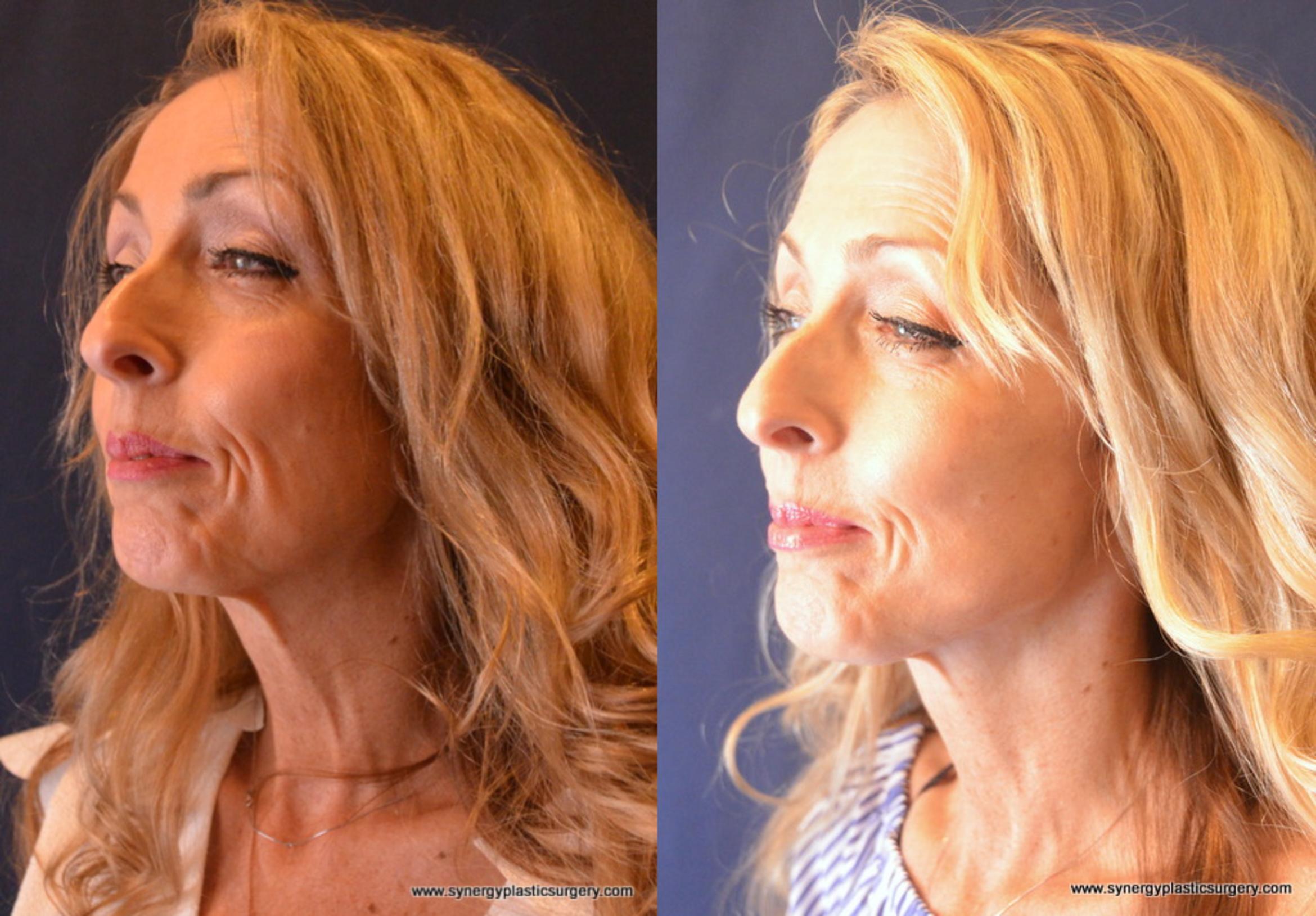 Before & After Facelift Case 680 View #1 View in Round Rock, TX