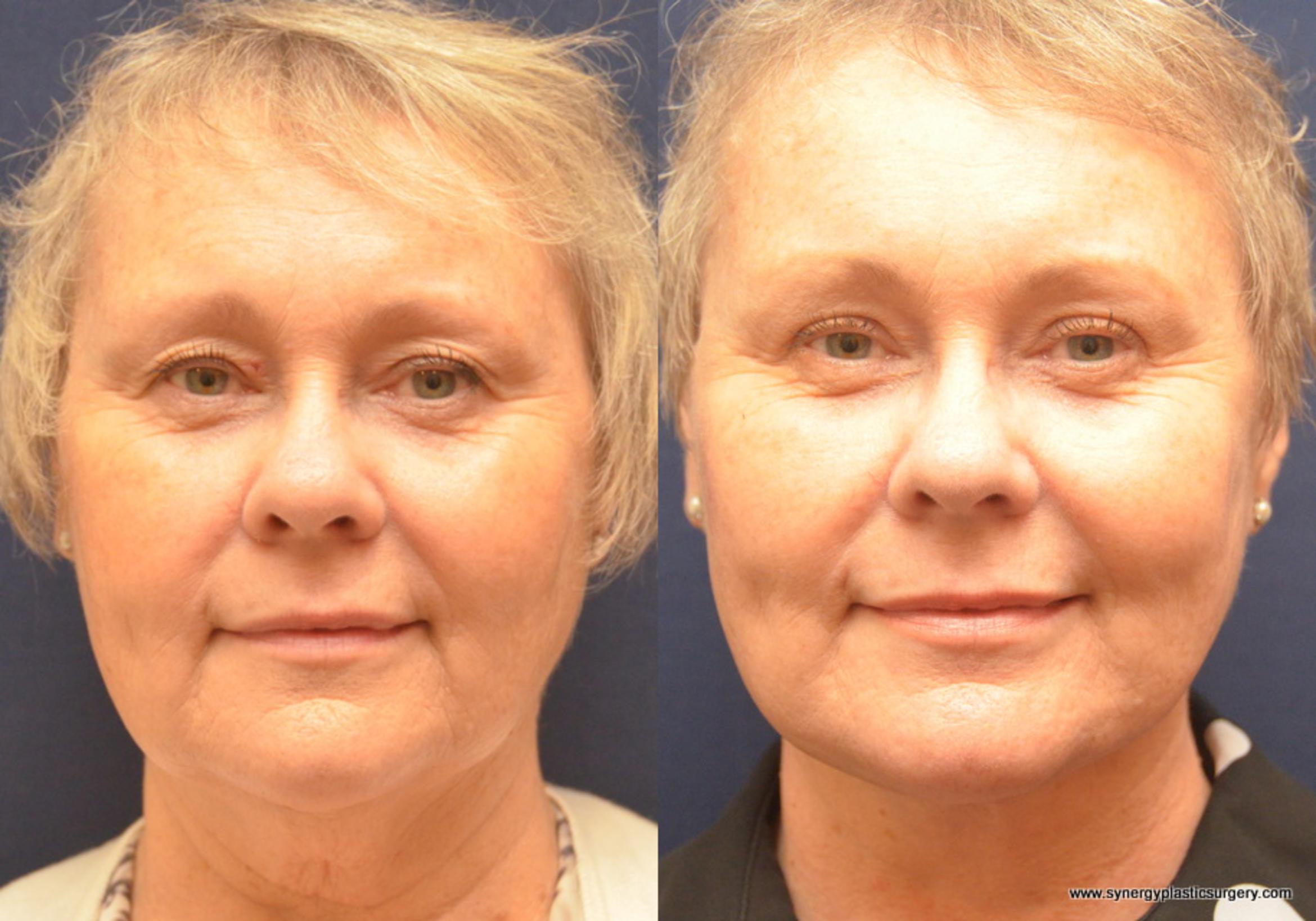 Before & After Facelift Case 688 View #1 View in Round Rock, TX