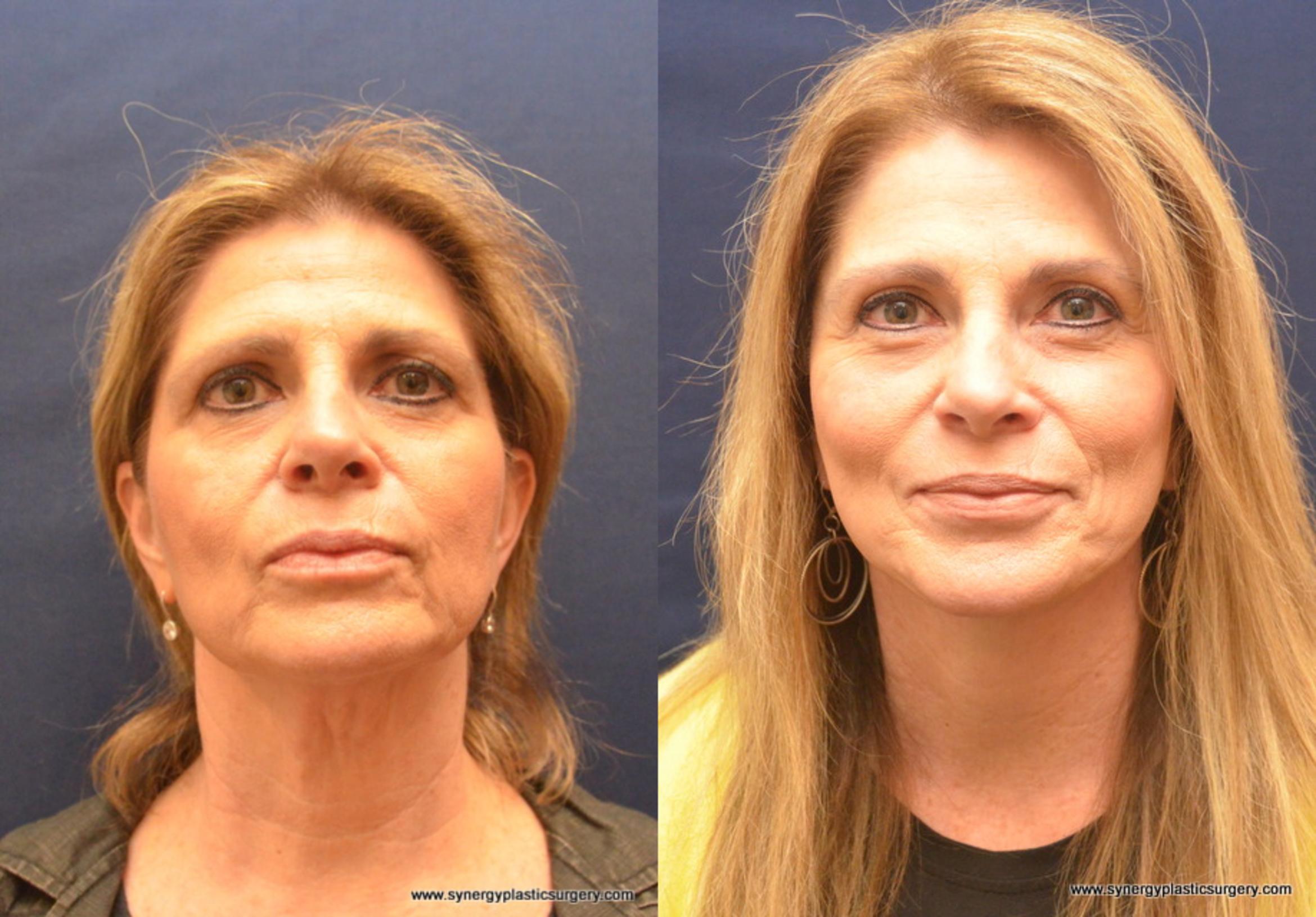 Before & After Facelift Case 743 View #1 View in Round Rock, TX
