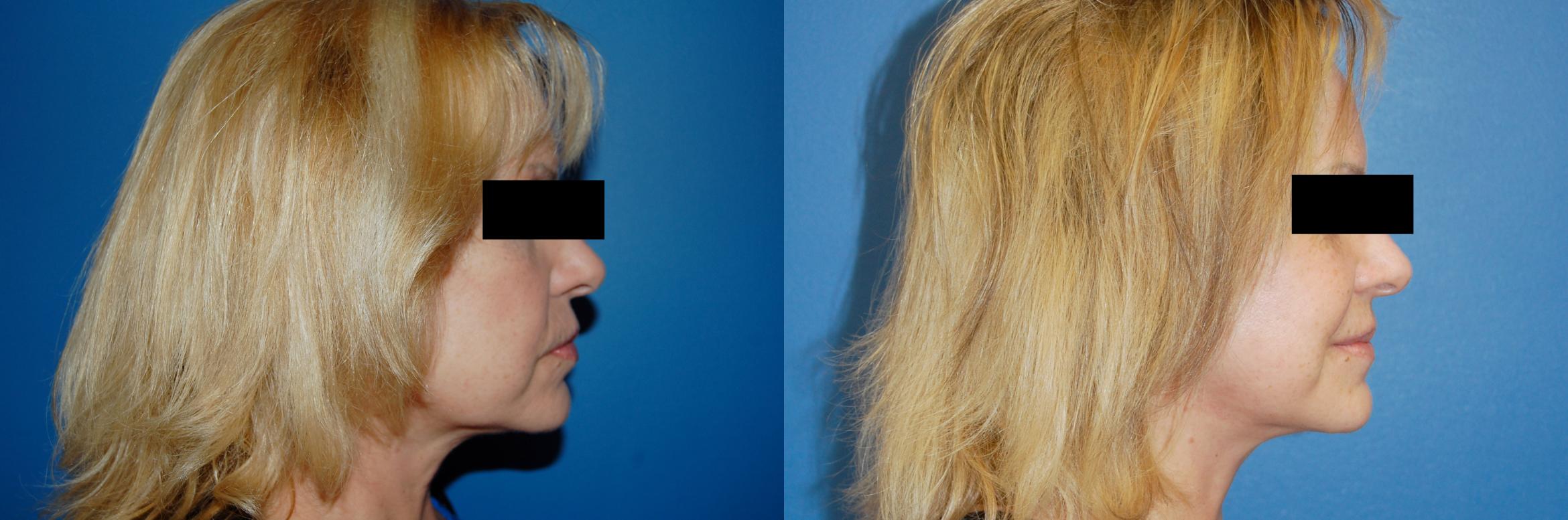 Facelift Before and After Pictures Case 9 Round Rock, TX Synergy
