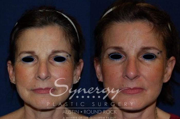 Before & After Facelift Case 123 View #2 View in Austin, TX