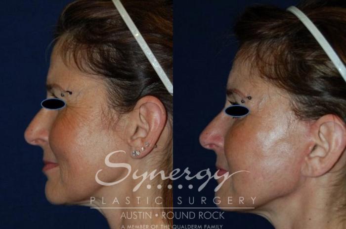 Before & After Facelift Case 123 View #3 View in Austin, TX