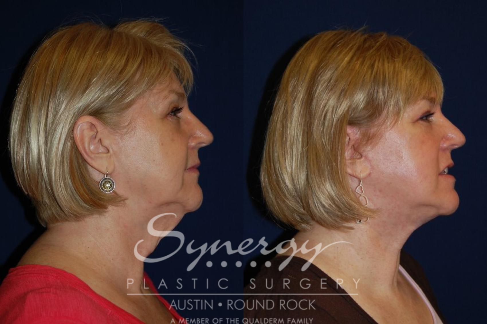 Before & After Facelift Case 128 View #2 View in Austin, TX
