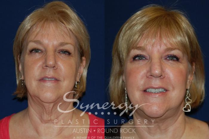 Before & After Facelift Case 128 View #4 View in Austin, TX