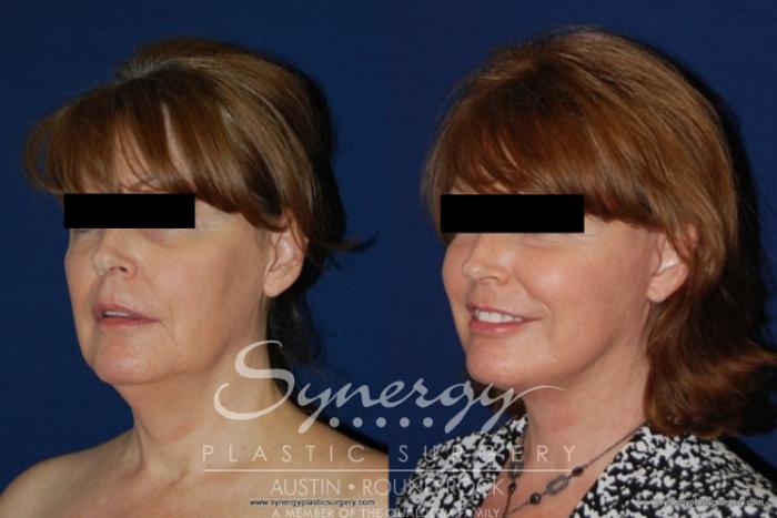 Before & After Facelift Case 177 View #1 View in Round Rock, TX