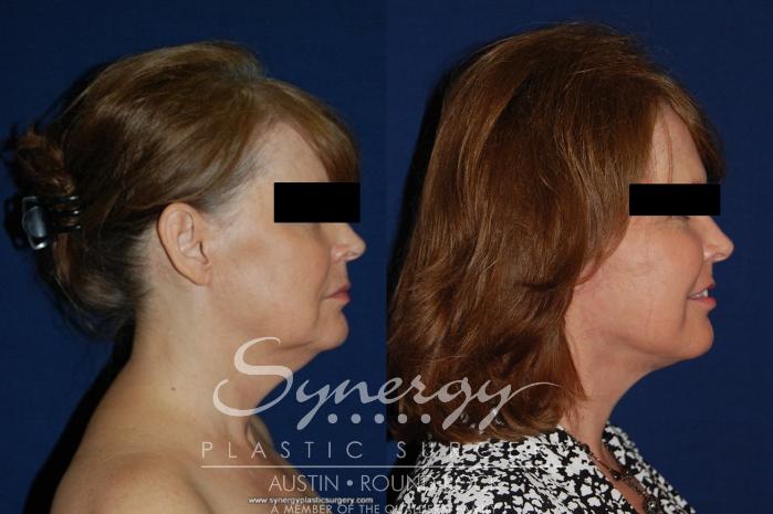 Before & After Facelift Case 177 View #3 View in Austin, TX