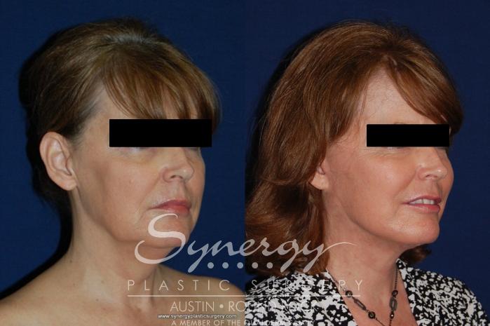 Before & After Facelift Case 177 View #4 View in Austin, TX