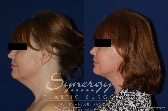 Before & After Facelift Case 177 View #5 View in Austin, TX