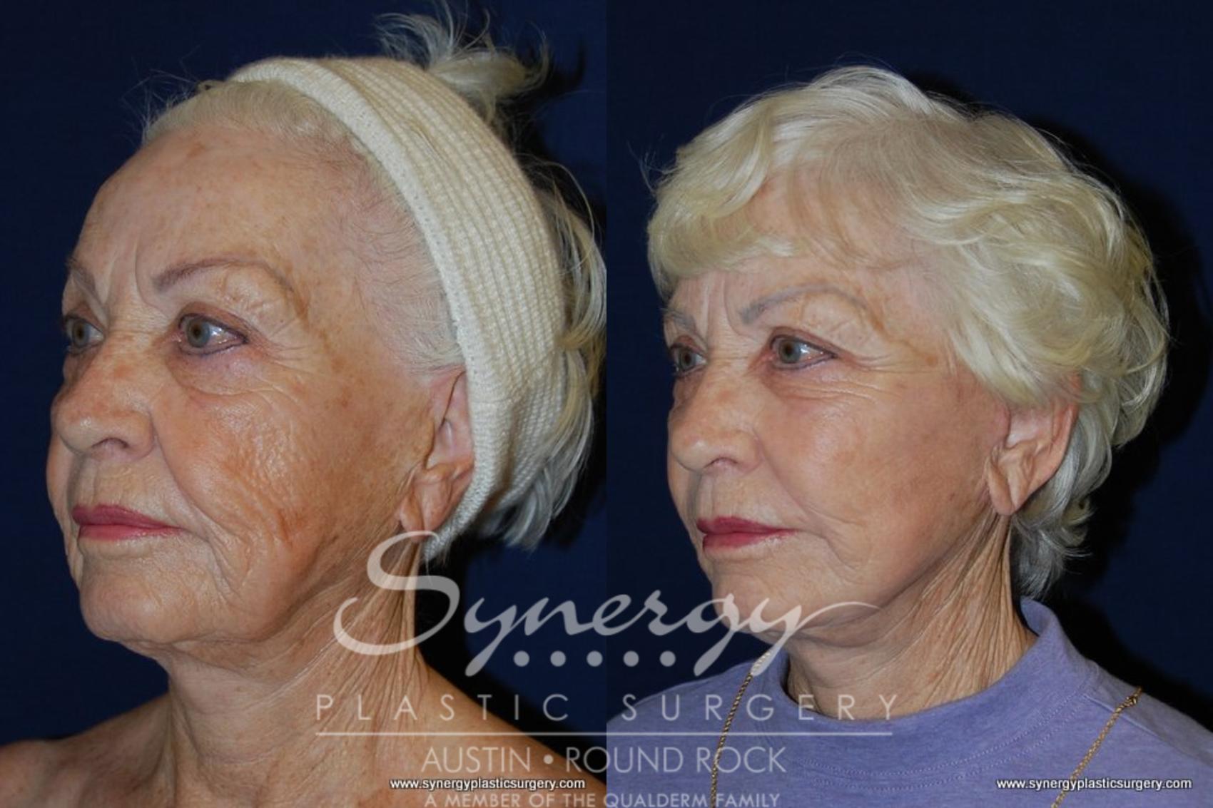Before & After Facelift Case 199 View #1 View in Round Rock, TX