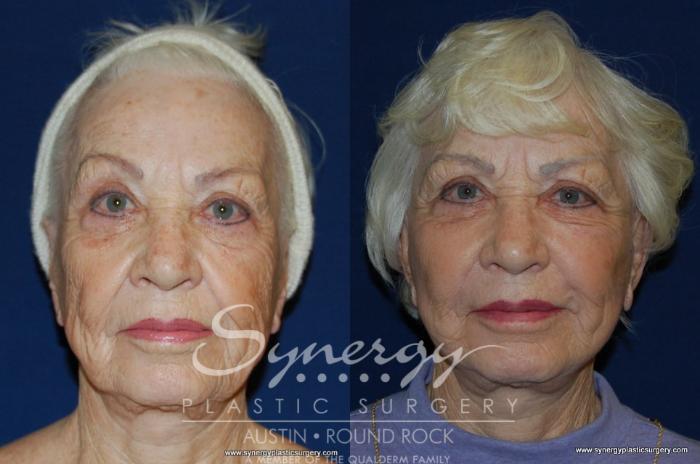 Before & After Facelift Case 199 View #2 View in Austin, TX