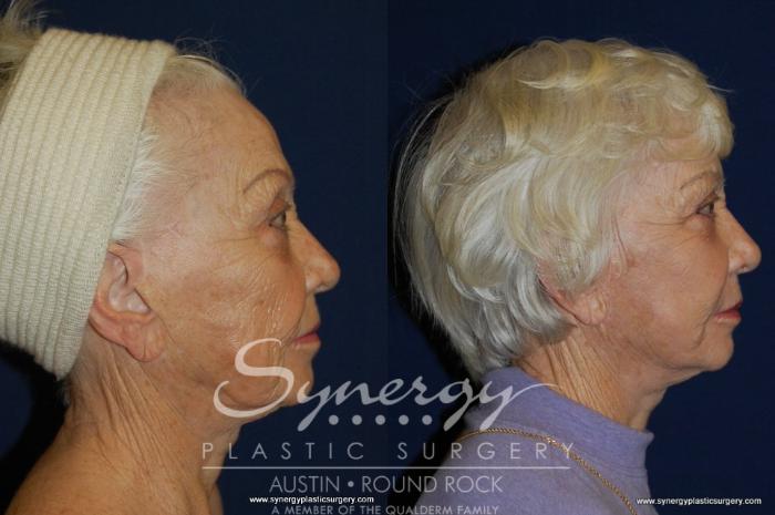 Before & After Facelift Case 199 View #3 View in Austin, TX