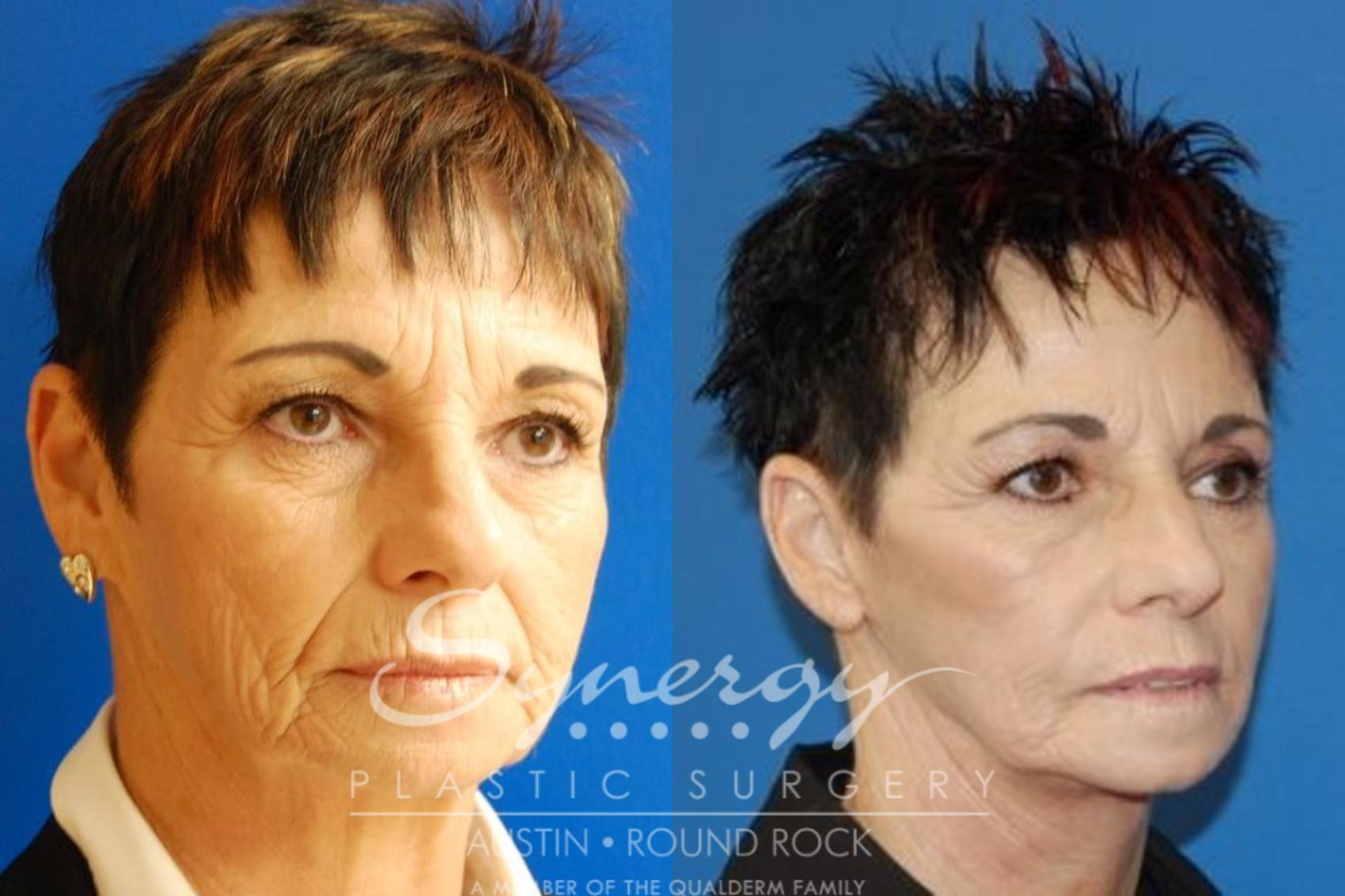 Before & After Facelift Case 26 View #5 View in Austin, TX