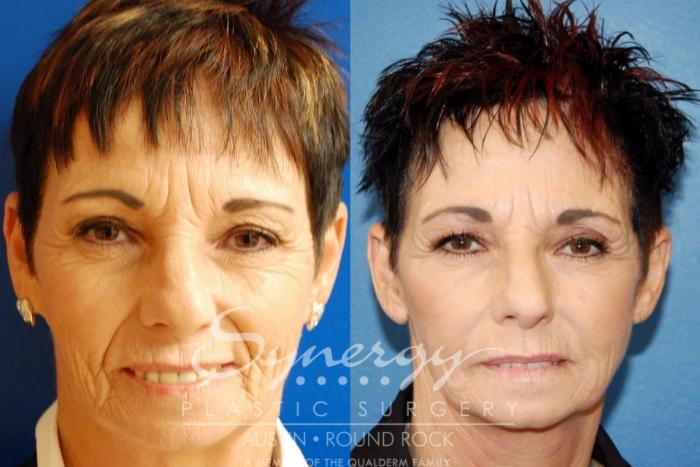 Before & After Facelift Case 26 View #6 View in Austin, TX