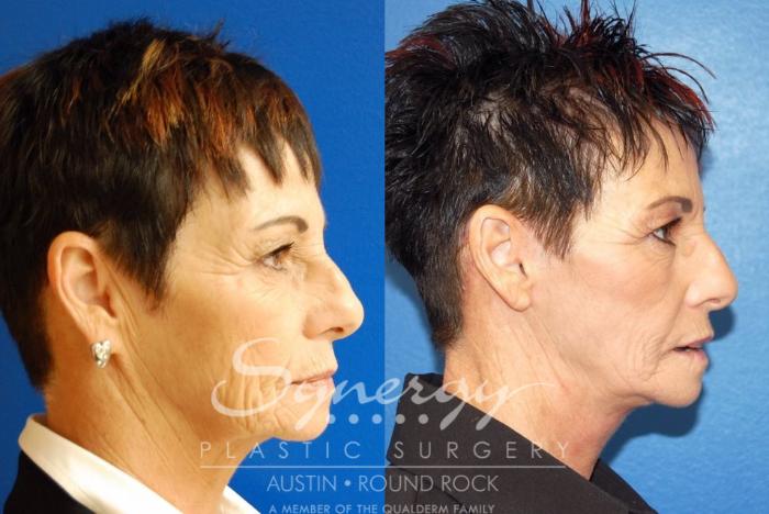 Before & After Facelift Case 26 View #7 View in Austin, TX