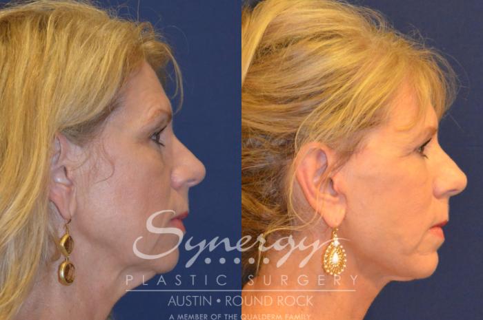 Before & After Facelift Case 296 View #2 View in Austin, TX