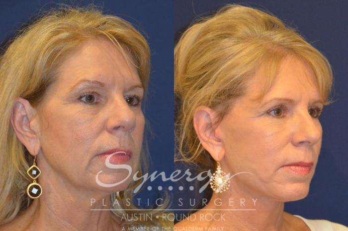 Before & After Facelift Case 296 View #3 View in Austin, TX