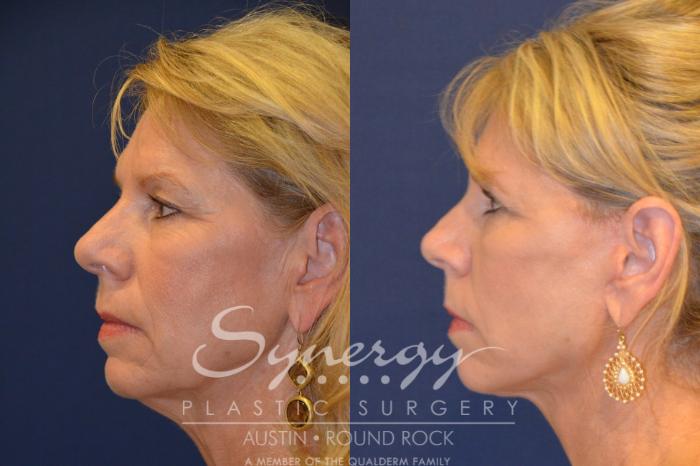 Before & After Facelift Case 296 View #4 View in Austin, TX