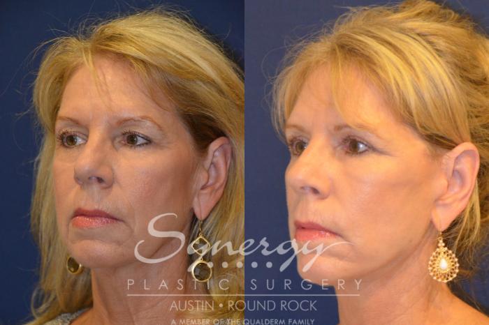 Before & After Facelift Case 296 View #5 View in Austin, TX