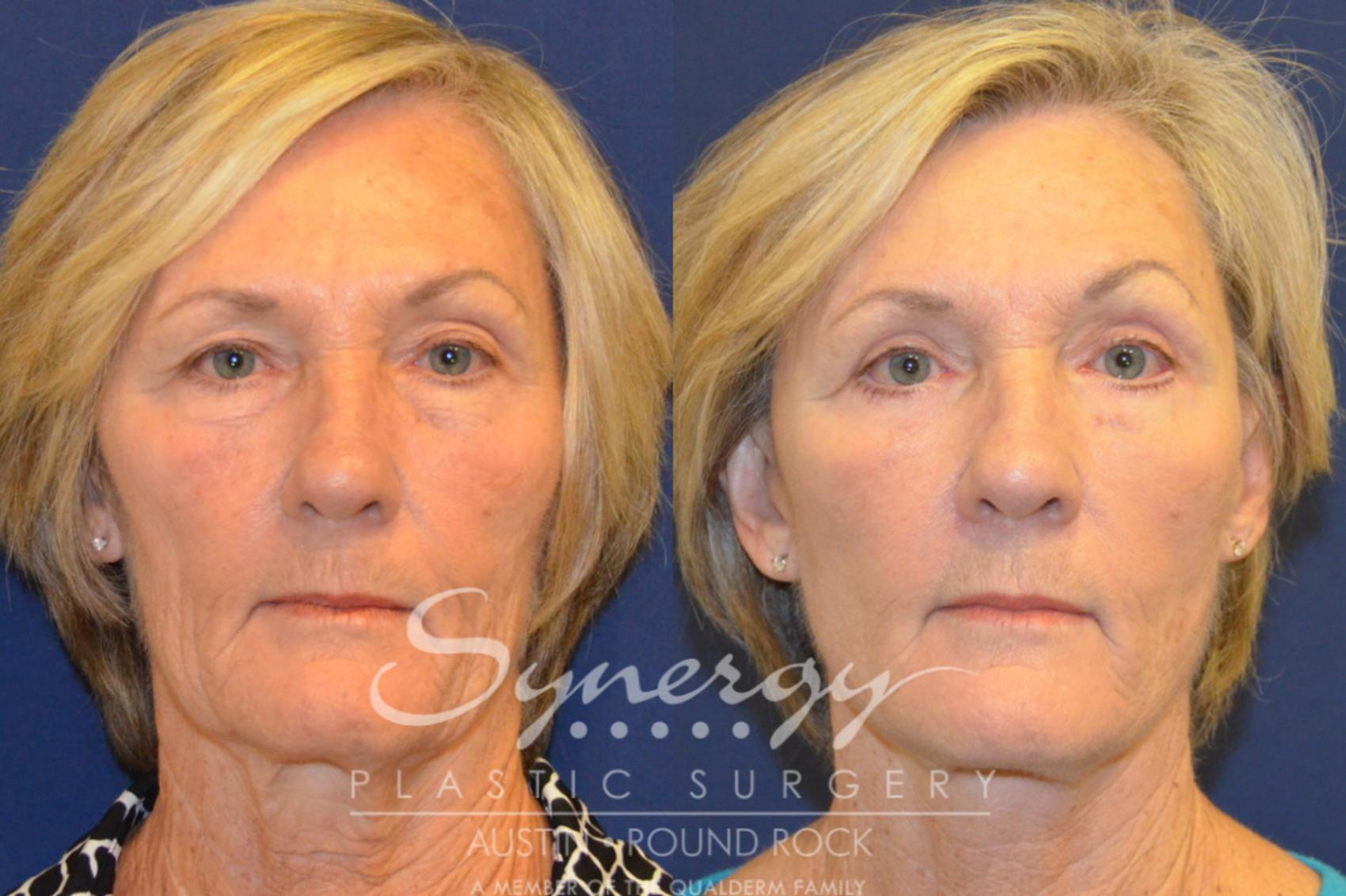 Before & After Facelift Case 367 View #1 View in Austin, TX