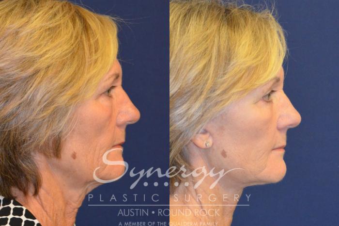 Before & After Facelift Case 367 View #2 View in Austin, TX